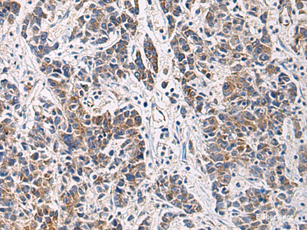 Immunohistochemistry of paraffin-embedded Human colorectal cancer tissue  using HSDL2 Polyclonal Antibody at dilution of 1:80(×200)