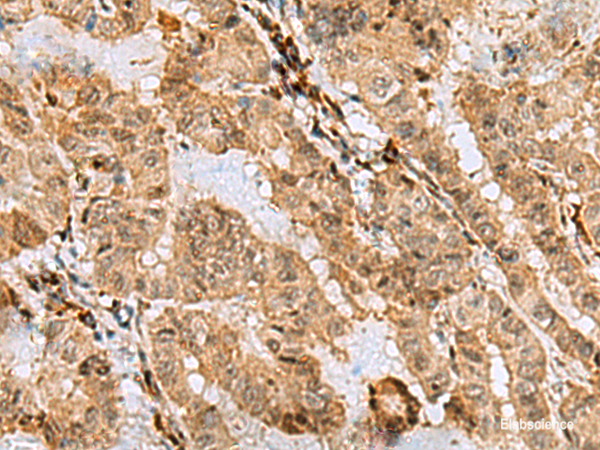 Immunohistochemistry of paraffin-embedded Human thyroid cancer tissue  using ASNA1 Polyclonal Antibody at dilution of 1:70(×200)
