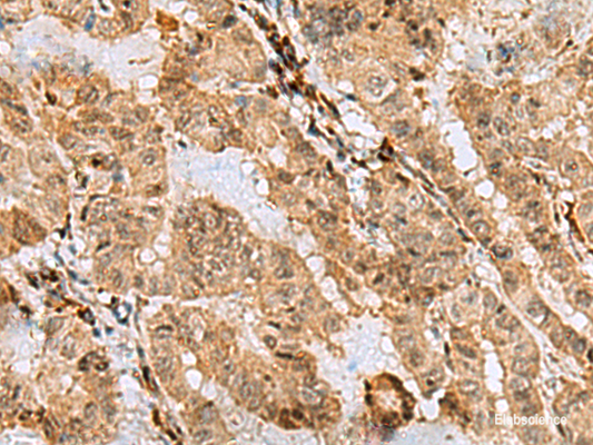 Immunohistochemistry of paraffin-embedded Human thyroid cancer tissue  using ASNA1 Polyclonal Antibody at dilution of 1:70(×200)