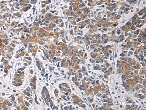 Immunohistochemistry of paraffin-embedded Human colorectal cancer tissue  using TMOD3 Polyclonal Antibody at dilution of 1:60(×200)