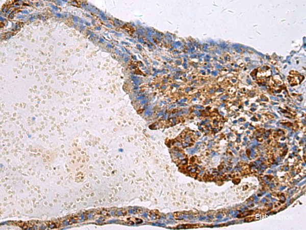 Immunohistochemistry of paraffin-embedded Human thyroid cancer tissue  using GNAI1 Polyclonal Antibody at dilution of 1:100(×200)