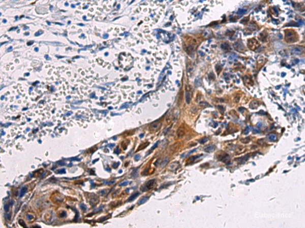 Immunohistochemistry of paraffin-embedded Human esophagus cancer tissue  using SORD Polyclonal Antibody at dilution of 1:45(×200)