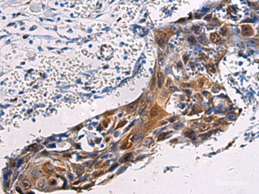 Immunohistochemistry of paraffin-embedded Human esophagus cancer tissue  using SORD Polyclonal Antibody at dilution of 1:45(×200)