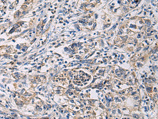 Immunohistochemistry of paraffin-embedded Human gastric cancer tissue  using CYTIP Polyclonal Antibody at dilution of 1:100(×200)
