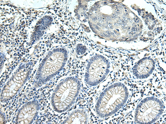 Immunohistochemistry of paraffin-embedded Human colorectal cancer tissue  using SLC35F6 Polyclonal Antibody at dilution of 1:115(×200)