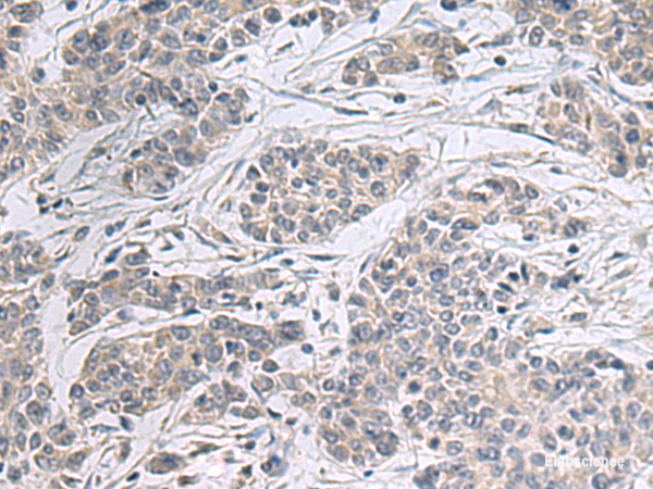 Immunohistochemistry of paraffin-embedded Human colorectal cancer tissue  using PPM1K Polyclonal Antibody at dilution of 1:55(×200)
