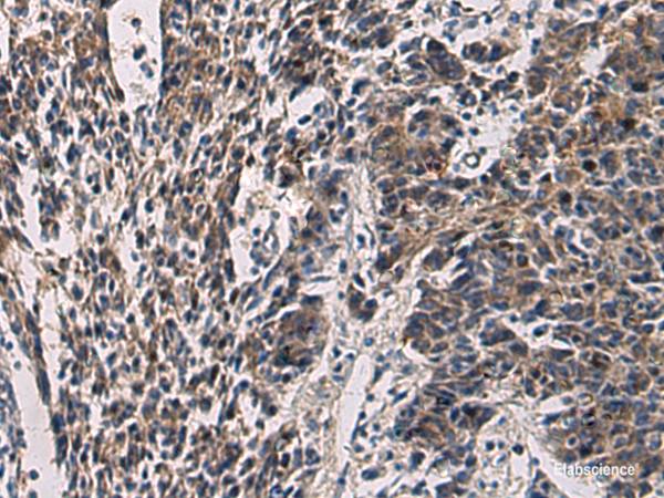 Immunohistochemistry of paraffin-embedded Human colorectal cancer tissue  using CCNI Polyclonal Antibody at dilution of 1:60(×200)