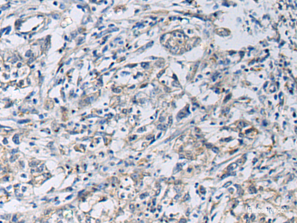 Immunohistochemistry of paraffin-embedded Human gastric cancer tissue  using KCNJ10 Polyclonal Antibody at dilution of 1:60(×200)