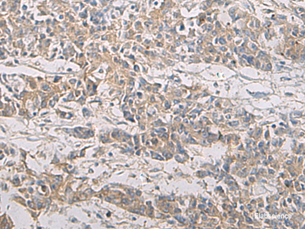 Immunohistochemistry of paraffin-embedded Human colorectal cancer tissue  using PA2G4 Polyclonal Antibody at dilution of 1:60(×200)