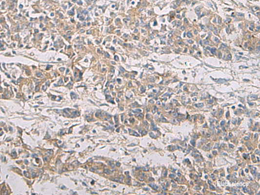 Immunohistochemistry of paraffin-embedded Human colorectal cancer tissue  using PA2G4 Polyclonal Antibody at dilution of 1:60(×200)