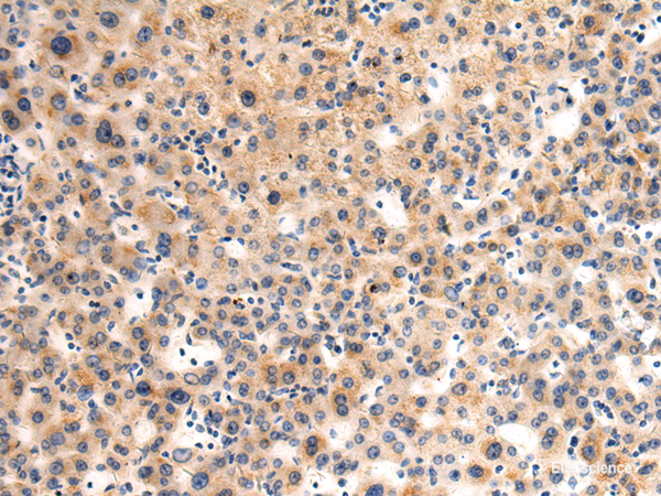 Immunohistochemistry of paraffin-embedded Human liver cancer tissue  using GLT8D1 Polyclonal Antibody at dilution of 1:90(×200)