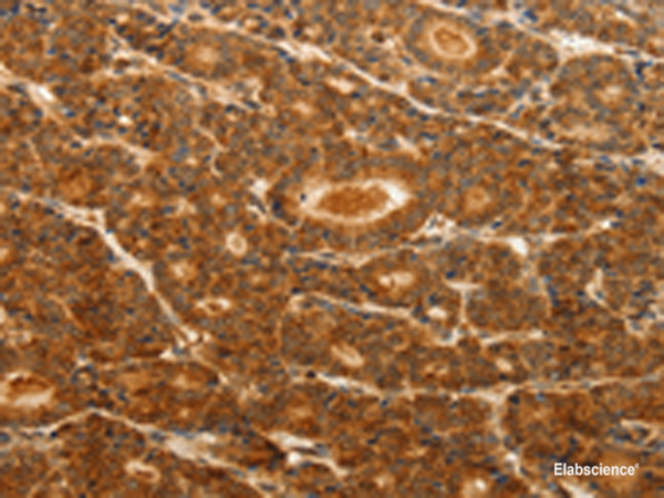 Immunohistochemistry of paraffin-embedded Human thyroid cancer tissue  using CDH5 Polyclonal Antibody at dilution of 1:30(×200)