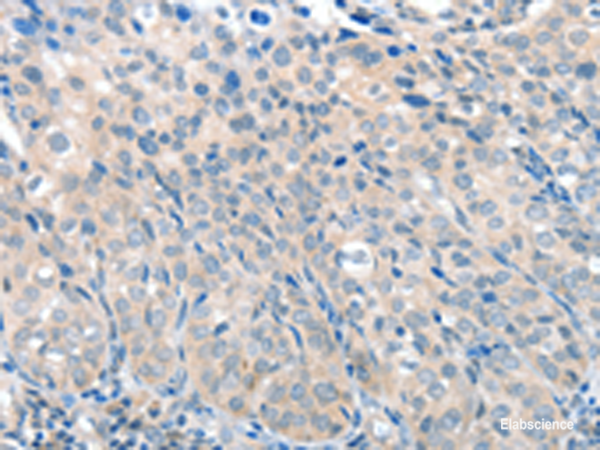 Immunohistochemistry of paraffin-embedded Human cervical cancer tissue  using SLC17A6 Polyclonal Antibody at dilution of 1:100(×200)