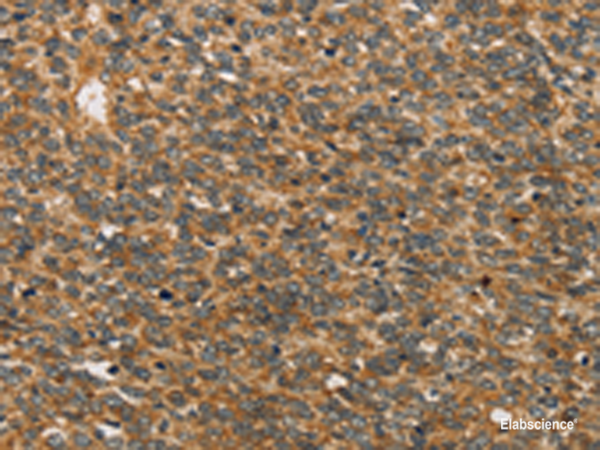 Immunohistochemistry of paraffin-embedded Human ovarian cancer tissue  using XPR1 Polyclonal Antibody at dilution of 1:45(×200)