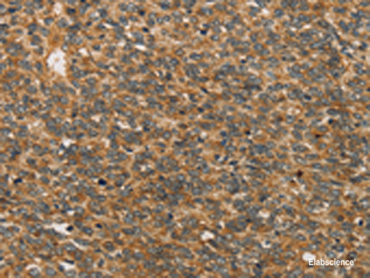 Immunohistochemistry of paraffin-embedded Human ovarian cancer tissue  using XPR1 Polyclonal Antibody at dilution of 1:45(×200)
