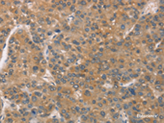Immunohistochemistry of paraffin-embedded Human liver cancer tissue  using ZADH2 Polyclonal Antibody at dilution of 1:51(×200)
