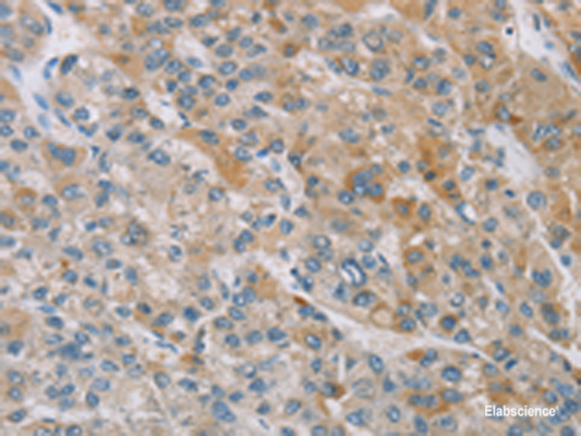 Immunohistochemistry of paraffin-embedded Human liver cancer tissue  using ZAK  Polyclonal Antibody at dilution of 1:100(×200)