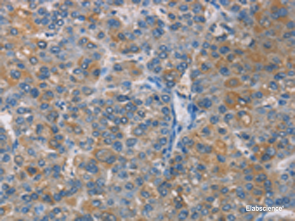 Immunohistochemistry of paraffin-embedded Human liver cancer tissue  using ZBTB1  Polyclonal Antibody at dilution of 1:50(×200)