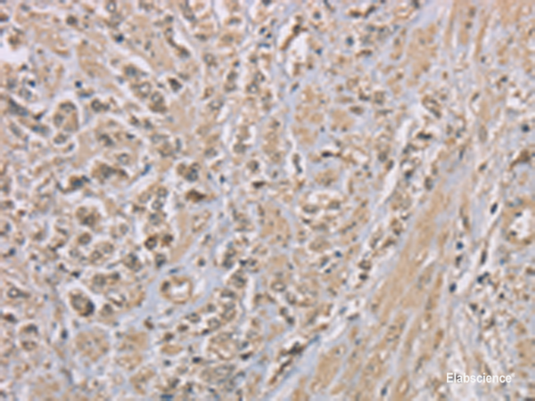 Immunohistochemistry of paraffin-embedded Human prost at e cancer tissue  using ZBTB2  Polyclonal Antibody at dilution of 1:50(×200)
