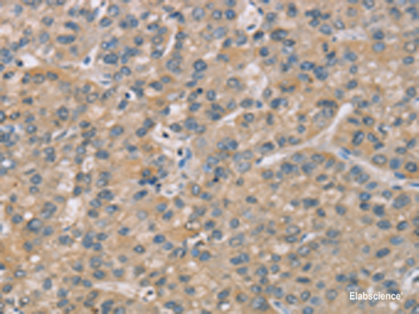 Immunohistochemistry of paraffin-embedded Human liver cancer tissue  using ZBTB3  Polyclonal Antibody at dilution of 1:50(×200)