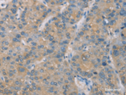 Immunohistochemistry of paraffin-embedded Human liver cancer tissue  using ZBTB6  Polyclonal Antibody at dilution of 1:50(×200)