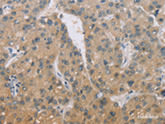 Immunohistochemistry of paraffin-embedded Human liver cancer tissue  using ZBTB6  Polyclonal Antibody at dilution of 1:50(×200)
