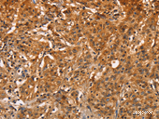 Immunohistochemistry of paraffin-embedded Human gastric cancer tissue  using ZFP64  Polyclonal Antibody at dilution of 1:60(×200)