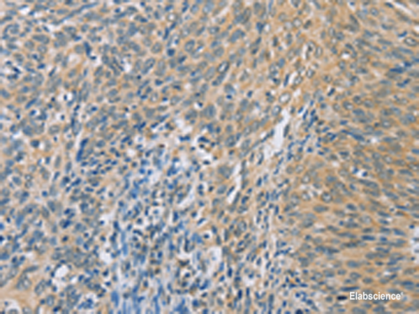 Immunohistochemistry of paraffin-embedded Human cervical cancer tissue  using ZHX3  Polyclonal Antibody at dilution of 1:100(×200)