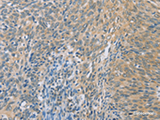 Immunohistochemistry of paraffin-embedded Human cervical cancer tissue  using ZHX3  Polyclonal Antibody at dilution of 1:100(×200)