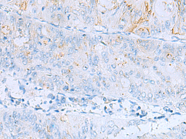 Immunohistochemistry of paraffin-embedded Human colorectal cancer tissue  using ERBB2 Polyclonal Antibody at dilution of 1:60(×200)