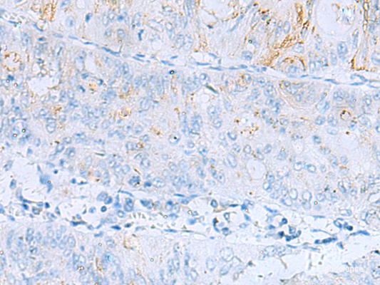 Immunohistochemistry of paraffin-embedded Human colorectal cancer tissue  using ERBB2 Polyclonal Antibody at dilution of 1:60(×200)
