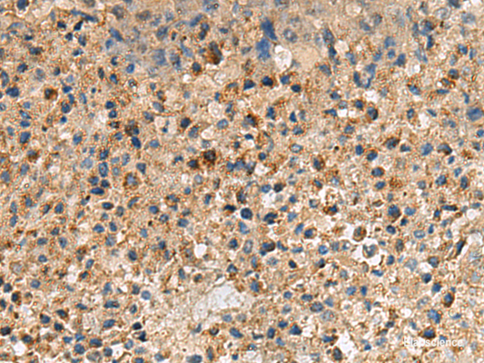 Immunohistochemistry of paraffin-embedded Human liver cancer tissue  using CXCR5 Polyclonal Antibody at dilution of 1:60(×200)