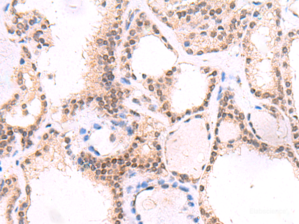 Immunohistochemistry of paraffin-embedded Human thyroid cancer tissue  using MYOD1 Polyclonal Antibody at dilution of 1:50(×200)