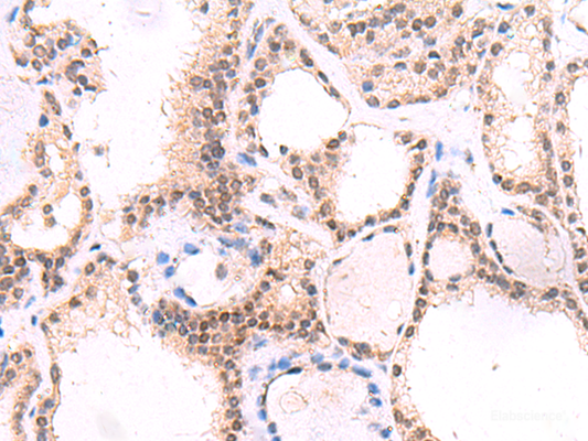 Immunohistochemistry of paraffin-embedded Human thyroid cancer tissue  using MYOD1 Polyclonal Antibody at dilution of 1:50(×200)