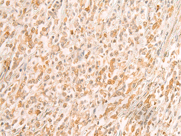 Immunohistochemistry of paraffin-embedded Human gastric cancer tissue  using SREBF2 Polyclonal Antibody at dilution of 1:50(×200)
