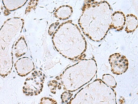 Immunohistochemistry of paraffin-embedded Human thyroid cancer tissue  using TH Polyclonal Antibody at dilution of 1:40(×200)