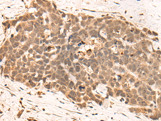 Immunohistochemistry of paraffin-embedded Human thyroid cancer tissue  using CLK2 Polyclonal Antibody at dilution of 1:45(×200)