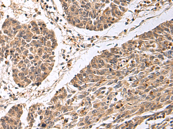 Immunohistochemistry of paraffin-embedded Human colorectal cancer tissue  using CD24 Polyclonal Antibody at dilution of 1:25(×200)