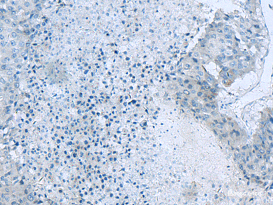 Immunohistochemistry of paraffin-embedded Human liver cancer tissue  using GLS Polyclonal Antibody at dilution of 1:60(×200)