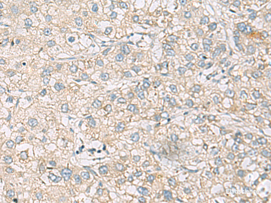 Immunohistochemistry of paraffin-embedded Human liver cancer tissue  using RAC2 Polyclonal Antibody at dilution of 1:60(×200)