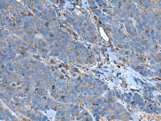 Immunohistochemistry of paraffin-embedded Human thyroid cancer tissue  using SLC24A5 Polyclonal Antibody at dilution of 1:50(×200)