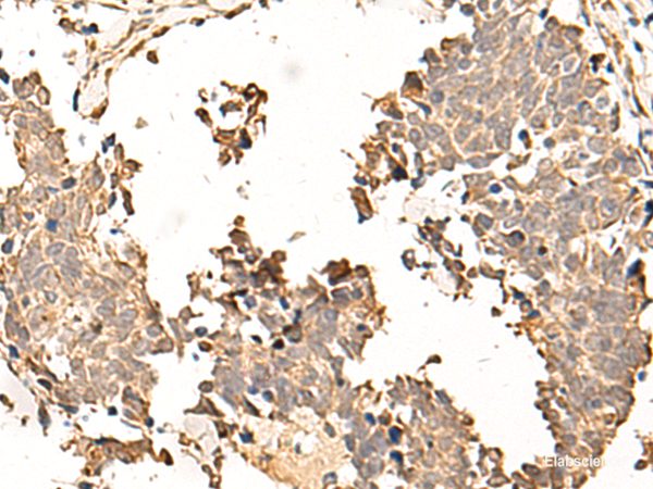 Immunohistochemistry of paraffin-embedded Human lung cancer tissue  using SOX3 Polyclonal Antibody at dilution of 1:50(×200)