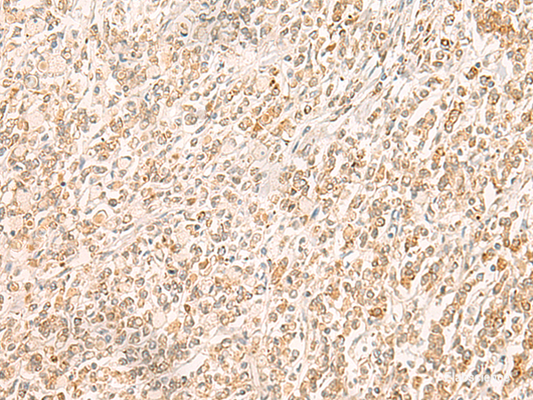 Immunohistochemistry of paraffin-embedded Human gastric cancer tissue  using MYCT1 Polyclonal Antibody at dilution of 1:35(×200)