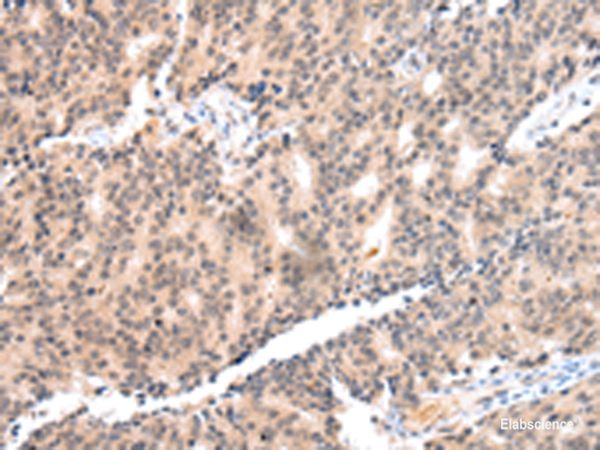 Immunohistochemistry of paraffin-embedded Human prost at e cancer tissue  using COX17 Polyclonal Antibody at dilution of 1:55(×200)