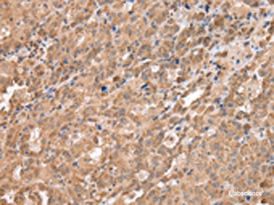 Immunohistochemistry of paraffin-embedded Human ovarian cancer tissue  using DDX58 Polyclonal Antibody at dilution of 1:40(×200)
