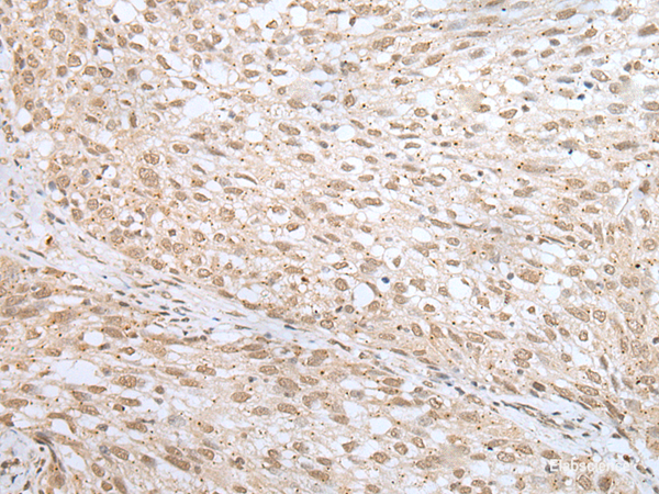 Immunohistochemistry of paraffin-embedded Human lung cancer tissue  using MORF4L1 Polyclonal Antibody at dilution of 1:45(×200)