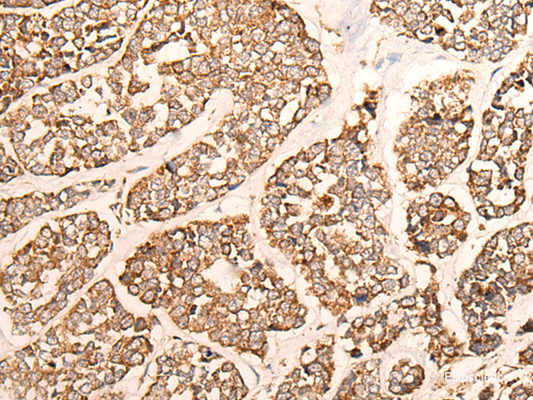 Immunohistochemistry of paraffin-embedded Human esophagus cancer tissue  using GRIA4 Polyclonal Antibody at dilution of 1:40(×200)