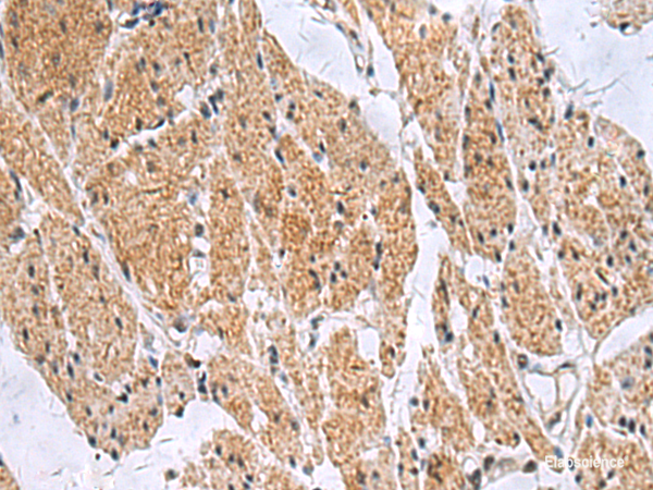 Immunohistochemistry of paraffin-embedded Human esophagus cancer tissue  using SLC4A3 Polyclonal Antibody at dilution of 1:35(×200)