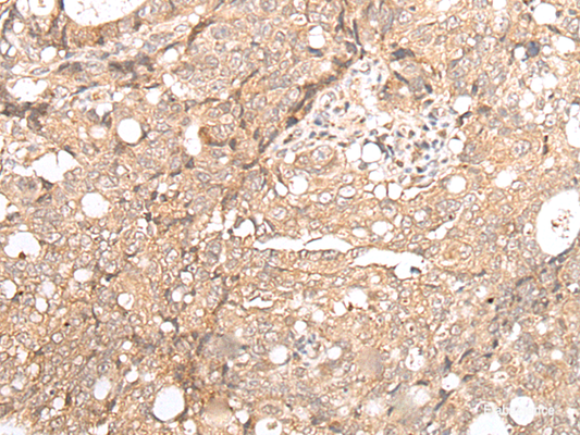 Immunohistochemistry of paraffin-embedded Human gastric cancer tissue  using FOXO4 Polyclonal Antibody at dilution of 1:70(×200)