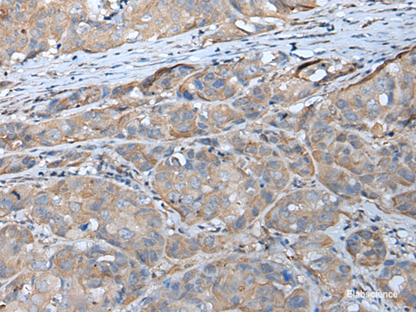 Immunohistochemistry of paraffin-embedded Human breast cancer tissue  using GPC5 Polyclonal Antibody at dilution of 1:40(×200)